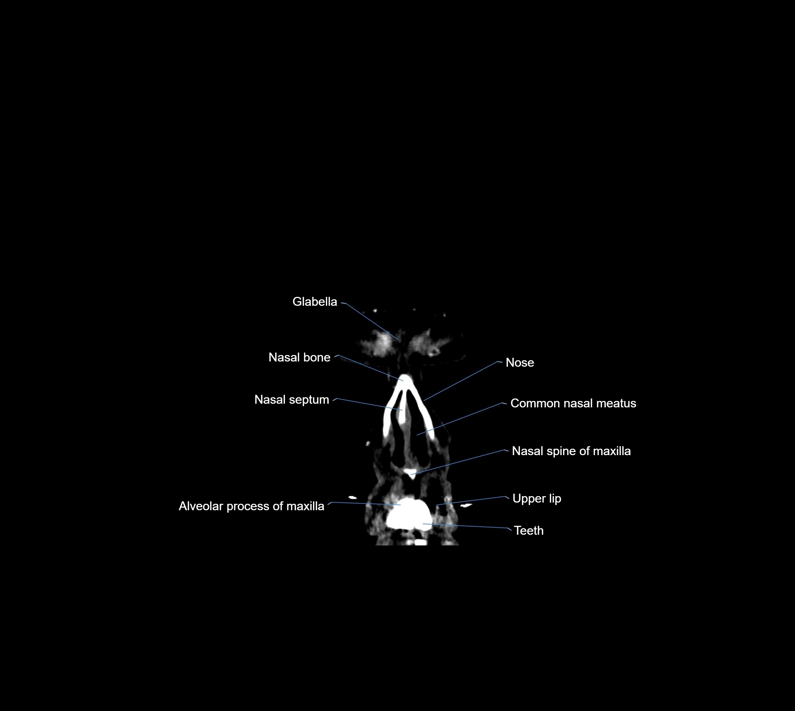 CT Brain coronal cross sectional radiology anatomy image  -img-00001-03.webp